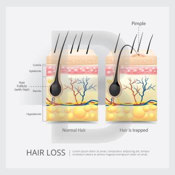 Hair Loss Structure Vector Illustration