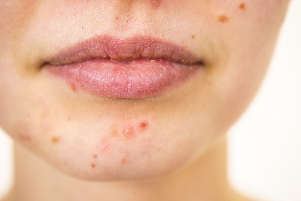 Young woman showing her face with acne and moles, dry lips. Teen girl no make up with red spots on her chin. Health problem, skin diseases.. Female face with acne skin problem