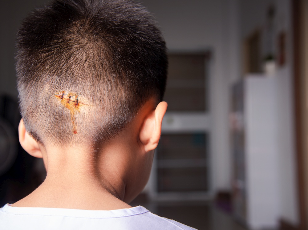 The lacerated sutured wound of kid back head which suture by nylon suture about 3 stitches at the emergency room of the hospital, Medical care of the surgery lesion on the head, children of Accident