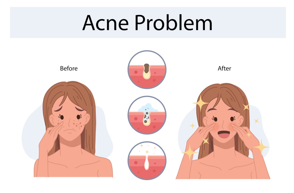 Upset woman with facial skin problem. infographic of acne disease and stages of treatment. Before and after. Vector illustration.
