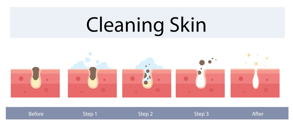 Facial skin care, pore cleaning concept. Cleansing stages on clogged face. Skin cleaning steps. Vector illustration.