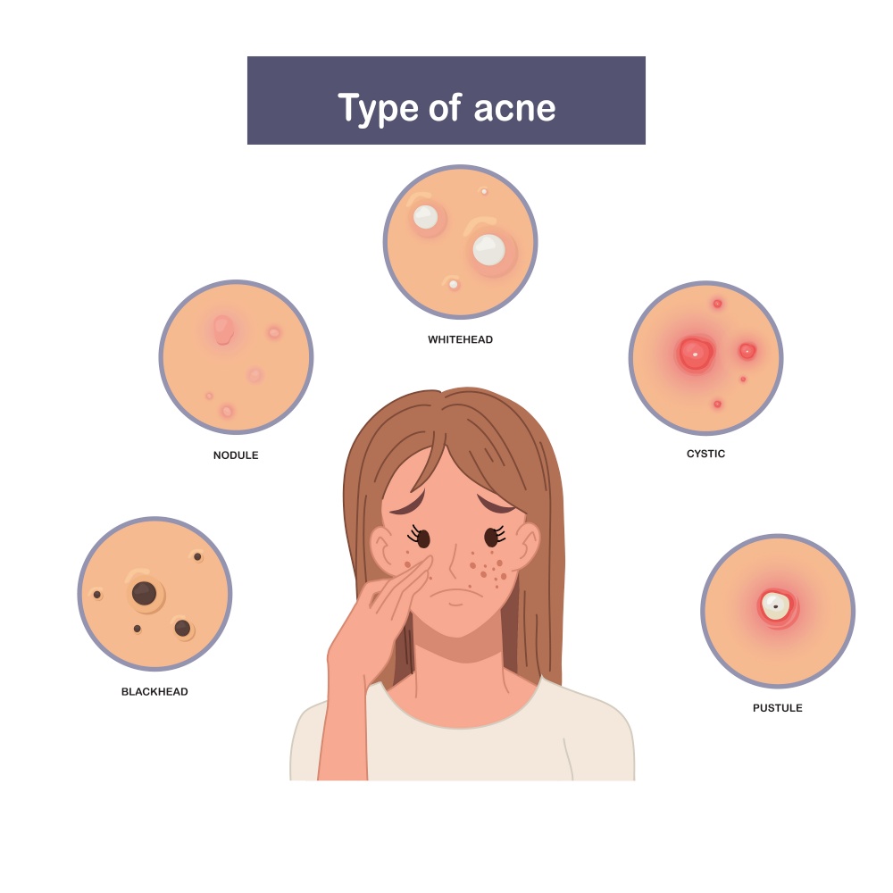 Infographic of Type of acne, sad and worried woman with acne. Flat vector illustration