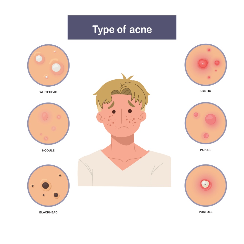 Infographic of Type of acne, sad and worried man with acne. Flat vector illustration
