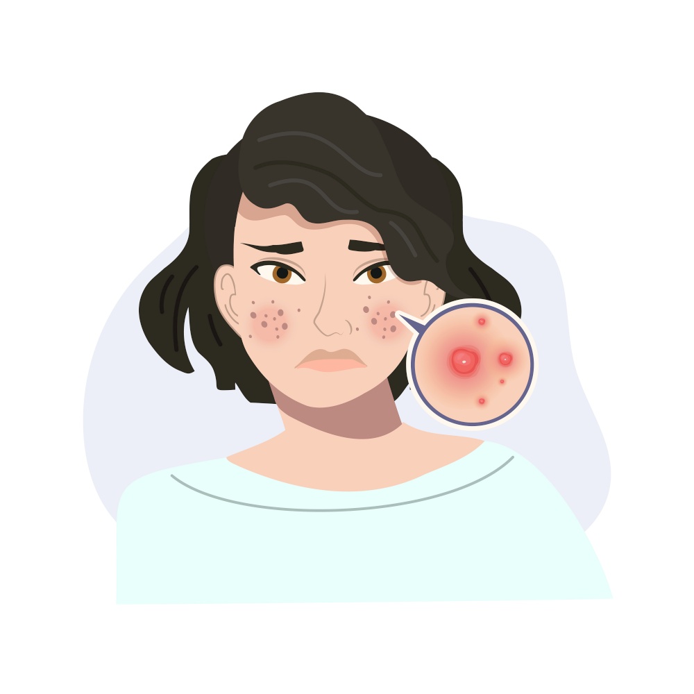 Portrait of Stressed Female with Troubled Skin. Acne, Cystic Skin Close Up. Flat vector cartoon illustration