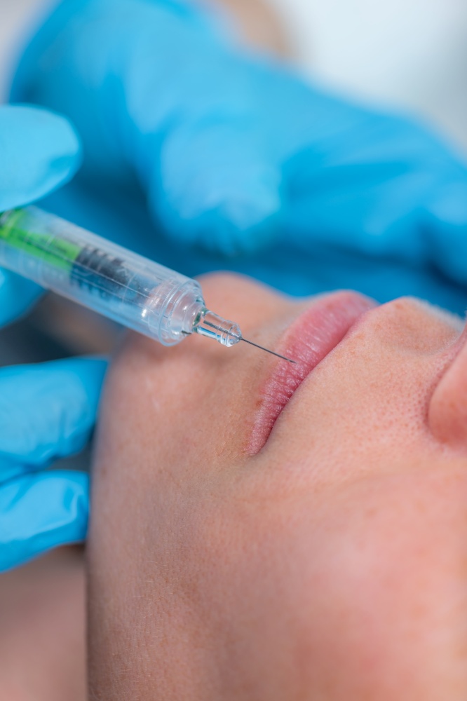 Treating lips with hyaluronic acid filler, a dermatology treatment that plumps up lips using hyaluronic acid.. Treating Lips with Hyaluronic Acid Fillers