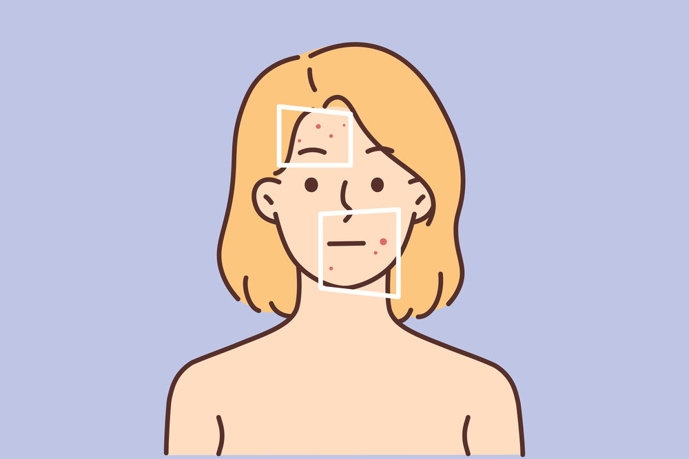 Naked woman with red pimples on face suffer from dermatitis. Unhappy female with redness or allergy struggle with facial problem. Skincare. Vector illustration. . Woman with red pimples on face