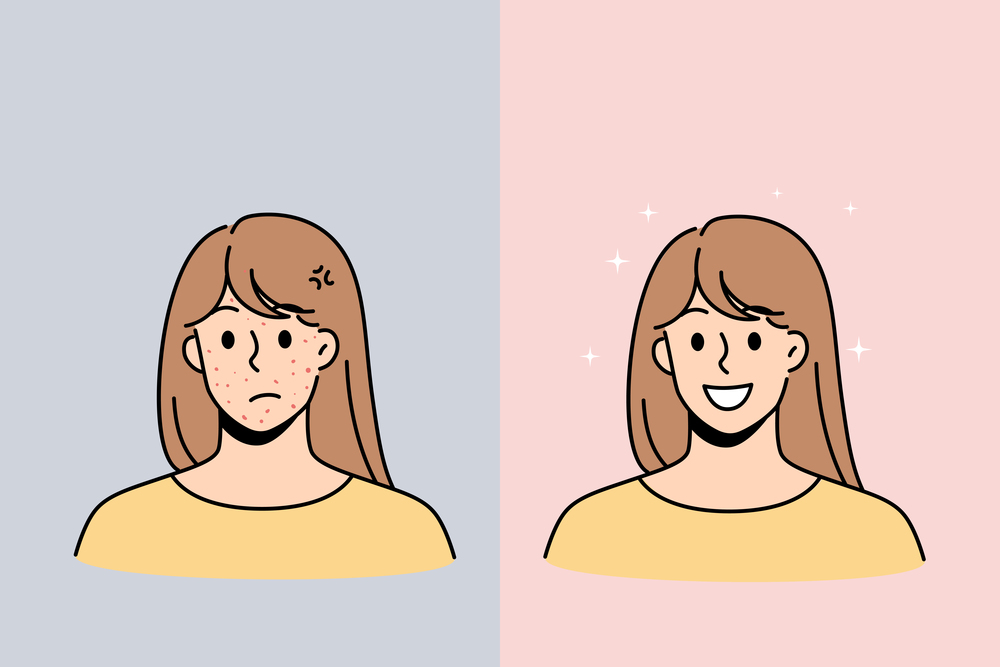 Skin problem and health concept. Stressed unhappy young woman with red acne pimples and smiling with healthy skin face vector illustration . Skin problem and health concept.