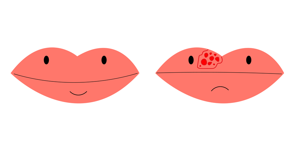 lips closeup with cold herpes, sore on the lip, vector.. lips closeup with cold herpes, sore on the lip, vector illustration