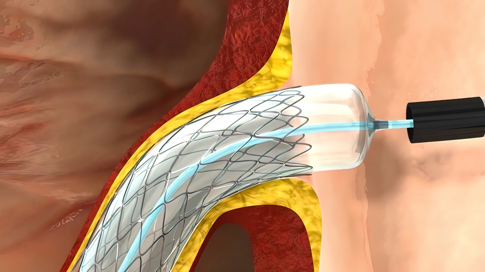 coronary angiography procedures 3D illustration. coronary angiography procedures 3d