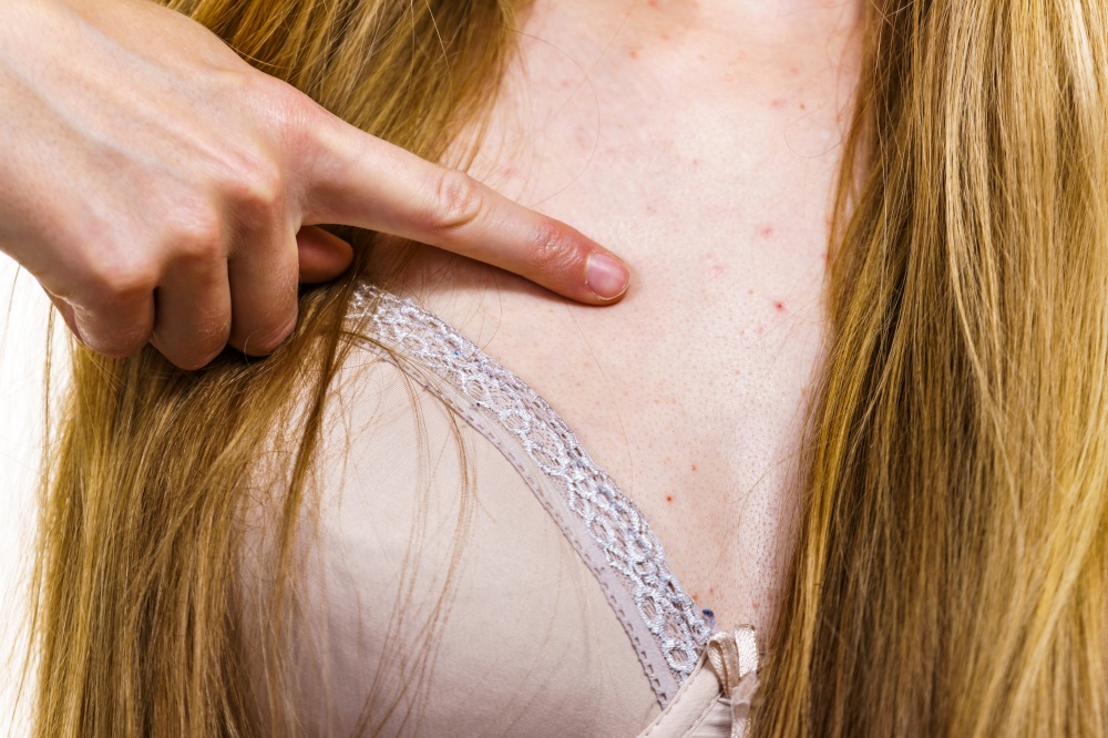 Health problem, skin diseases. Young woman showing her neckline with acne, red spots. Female with pimples.. Woman with skin problem acne on neckline