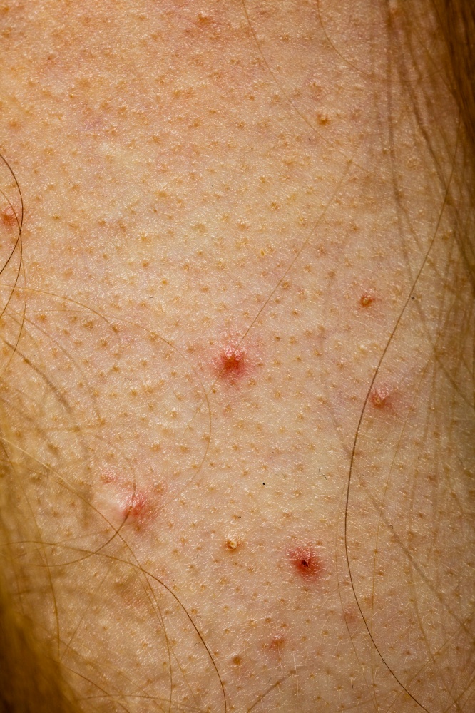 Close up of skin with acne moles and red spots. Health problem, skin diseases.. Closeup skin with acne moles and red spots.