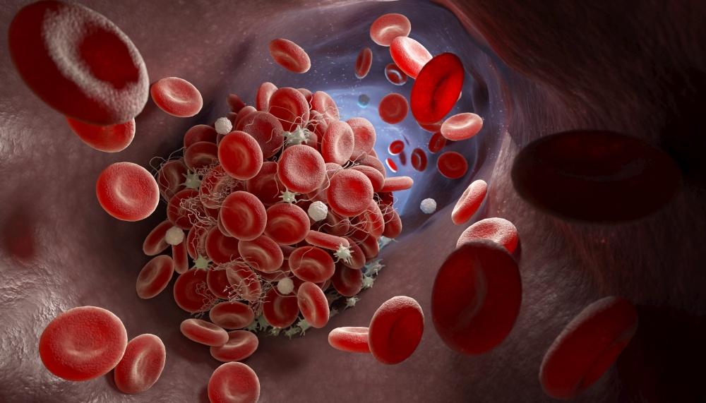 Depiction of a blood clot forming inside a blood vessel. 3D illustration. Formation of a blood clot