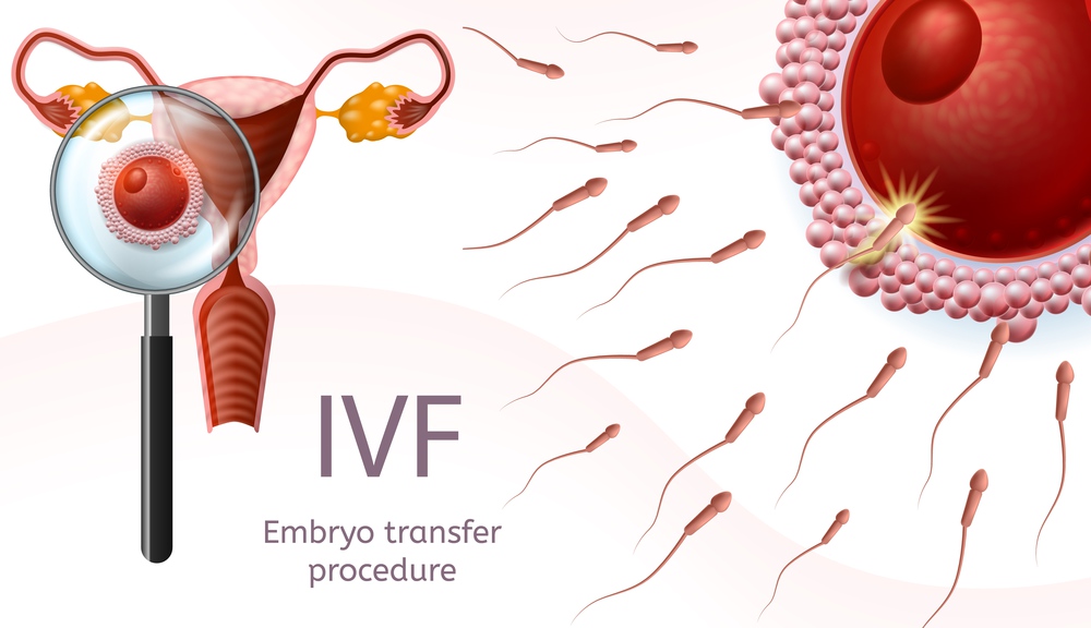 In Vitro Fertilization. Embryo Transfer Procedure. Female Uretus and Sperm Flow to Egg Cell. Magnifier Glass View. Reproductive Human System IVF Vector Realistic Illustration. Banner for Medical Use. In Vitro Fertilization. Embryo Transfer Procedure