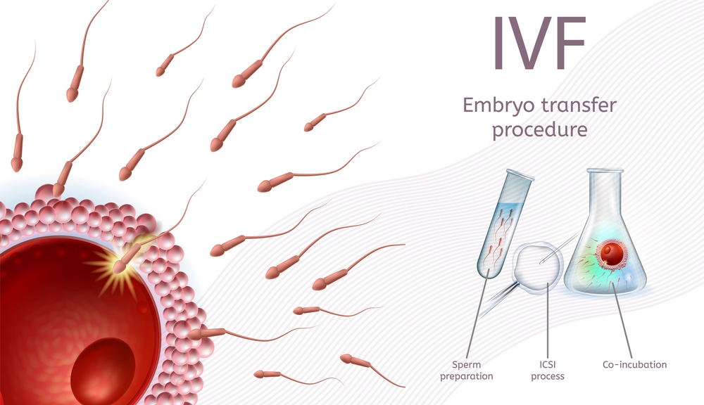 In Vitro Fertilization Embryo Transfer Procedure. IVF Process Chart with Schematic Explanations and Icons. Sperm Preparetion, ICSI Process, Co-Incubation. Realistic Vector Illustration, Medical Banner. In Vitro Fertilization Embryo Transfer Procedure.