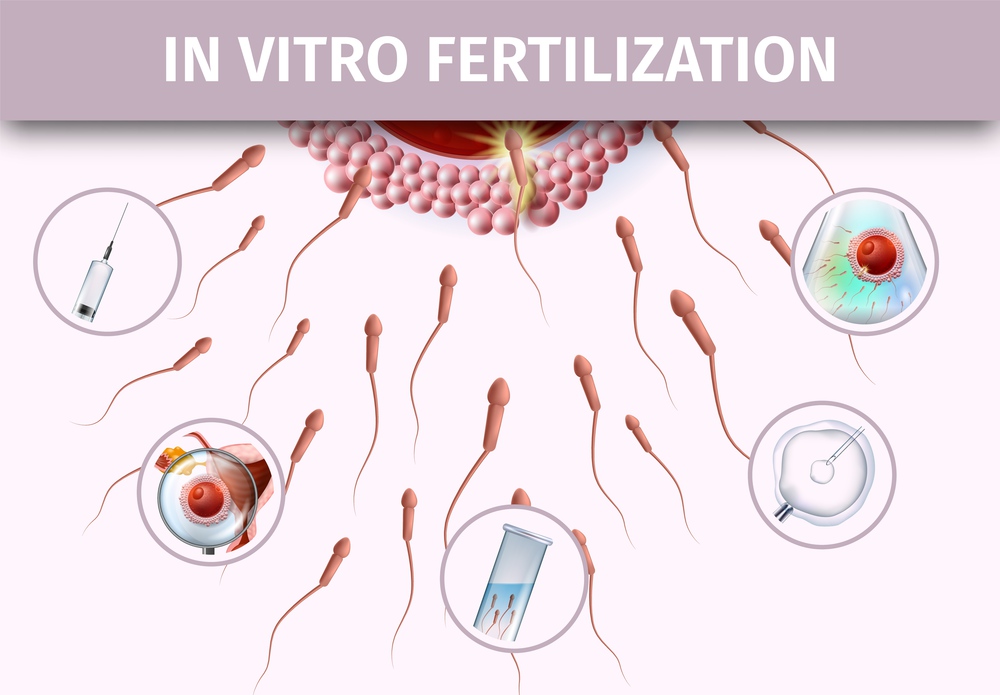 In Vitro Fertilization Process. Artificial Insemination Infographic. Scientific Medical Detailed Realistic Illustration on Light Pink Colored Background. Reproduction, IVF. Vector Banner. Artificial Insemination Infographic Aid Banner