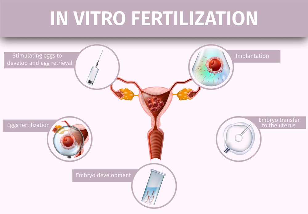 In Vitro Fertilization and Ovulation Medical Healthcare Background, Icons Steps of IVF. Spermatozoons and Female Egg. Artificial Insemination Poster. Vector Realistic Illustration. Banner, Copy Space.