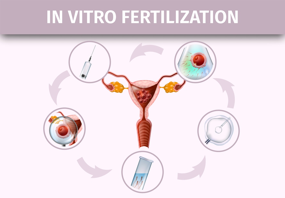 In Vitro Fertilization Stages Infographic. Human Reproduction. Union Female Egg and Sperm in Laboratory and Transportation to Uterus. IVF. Vector Realistic Illustration. Medical Banner, Copy Space.. Human In Vitro Fertilization Stages Infographic.