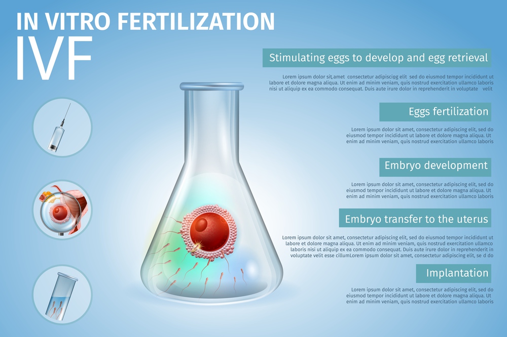 In Vitro Fertilization Stages Process Composition. Union of Human Egg and Sperm Inside of Beaker. Spermatozoons in Test Tube. Reproductive System Technology. IVF. Vector Realistic Illustration. Banner