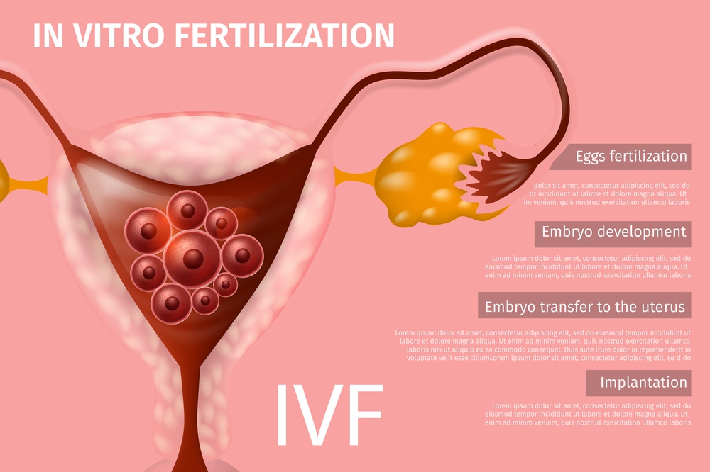 Laboratory Womans Eggs In Vitro Fertilization, Embryo Development and Transfer to Uretrus, Implantation. Female Reproductive System, IVF. Vector Realistic Illustration. Medical Banner, Copy Space.