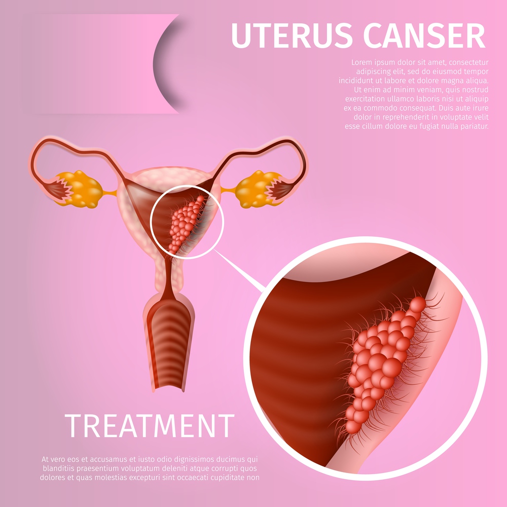 Uterus Cancer. Treatment. Oncological Disorder of Female Reproductive System. Medical Banner Chart with Cancerous Tumor Cells on Uterine Endometrium Tissue. Vector Realistic Illustration. Copy Space. Oncological Disorder of Female Reproductive System