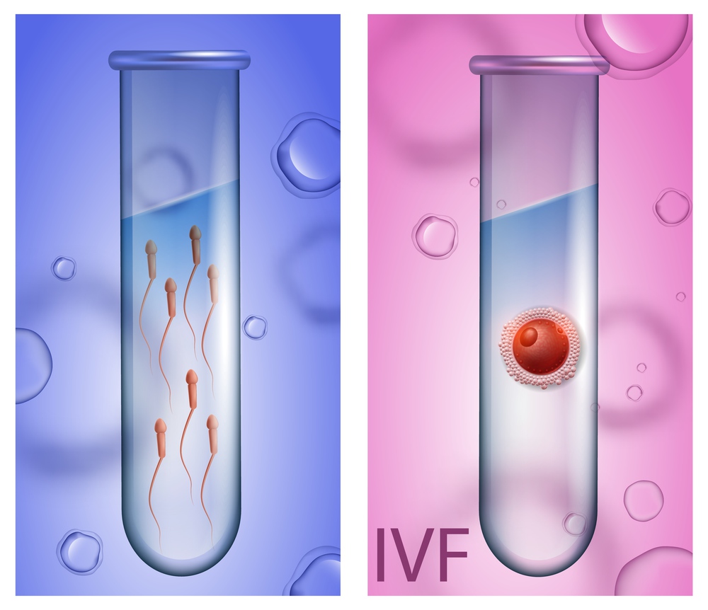 In Vitro Fertilization Vertical Banners. Male Test Tube with Active Spermatozoons on Blue Background, Female Beaker with Egg Cell on Pink Backdrop. IVF. Vector Realistic Illustration for Medical Use. Male Test Tube with Sperm, Female Beaker with Egg