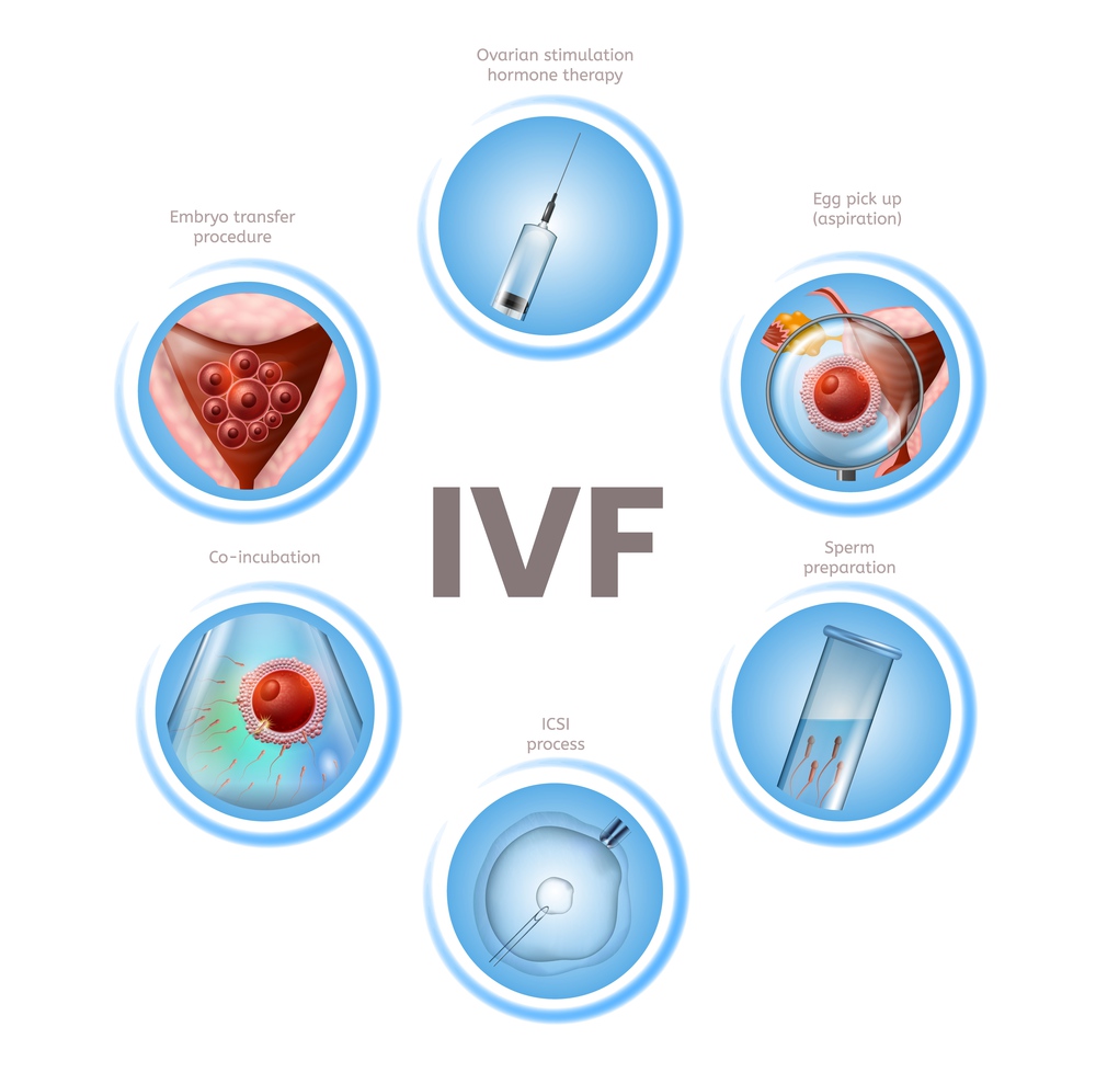 In Vitro Fertilization Infographics. Labeled Round Icons of IVF Stages Isolated on White Background. Human Assisted Reproductive Technology. Vector Realistic Illustration. Medical Educational Banner