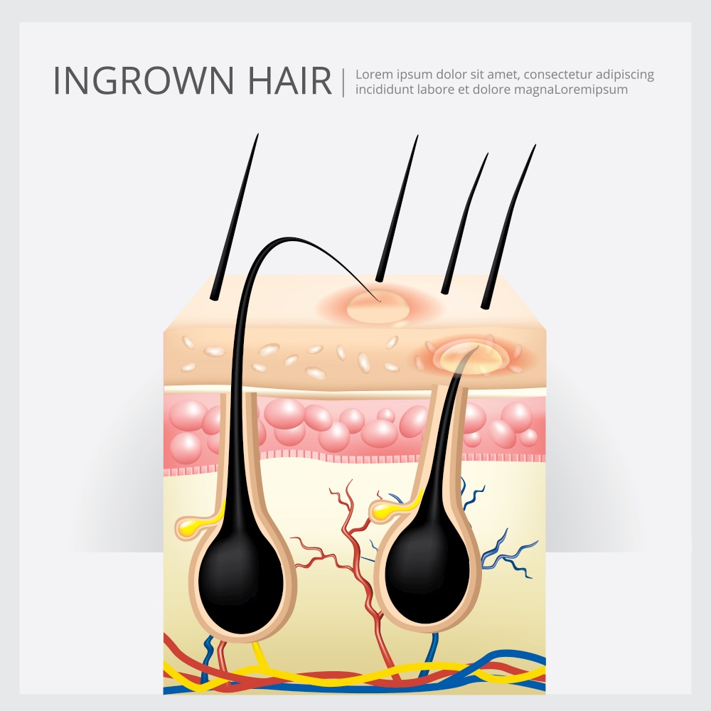 Ingrown Hair Structure Vector Illustration