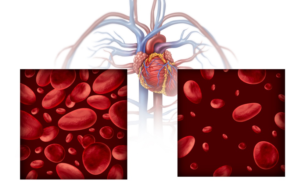 Anemia and anaemia medical diagram concept as normal and abnormal blood cell count and human circulation in an artery or vein as a 3D illustration on a white background.